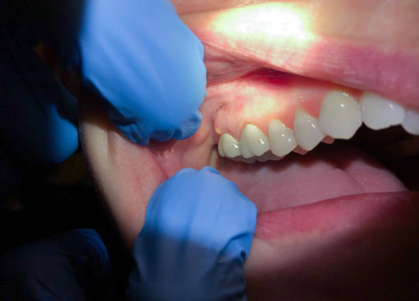 Best Emergency Broken Tooth Repair in Berea, KY